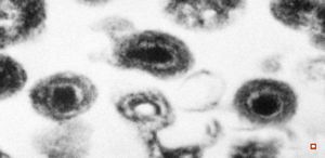 cytomegalovirus - pneumonia
